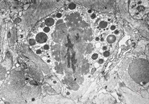 M,11y. | fibrillary astrocytoma M,11y. | fibrillary astrocytoma